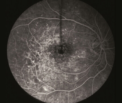 Fluorescein Angiography Macular Edema 2