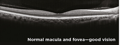 Optical Coherence Tomography and Macular Edema 1