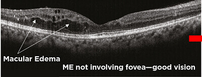 Optical Coherence Tomography and Macular Edema 2