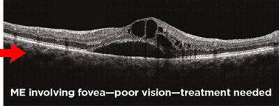 Optical Coherence Tomography and Macular Edema 3