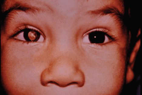 child with eye problems