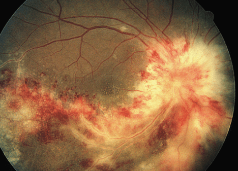 close up of retina with retinitis