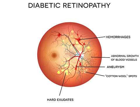 Retina Test, Fundus Checkup, Dilated test, Diabetes in retina