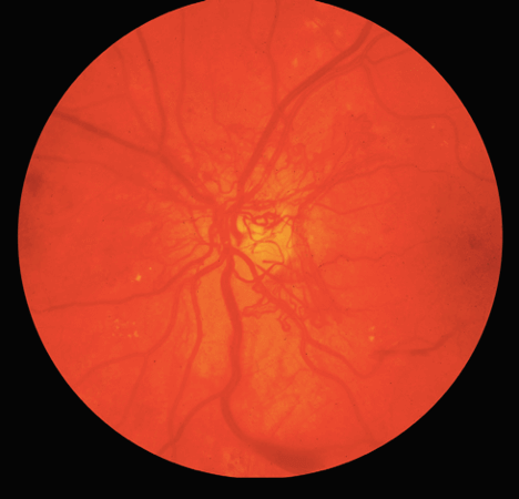Retinal fundus photo