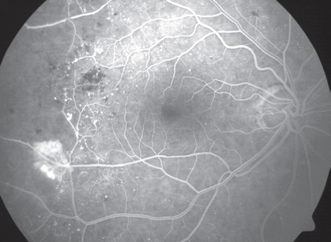 FA of a patient with proliferative diabetic retinopathy