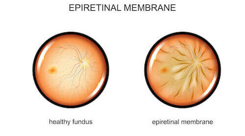 epiretinal membrane diagram
