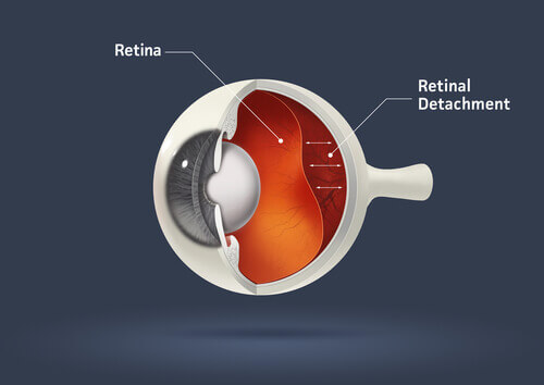 retinal detachment diagram